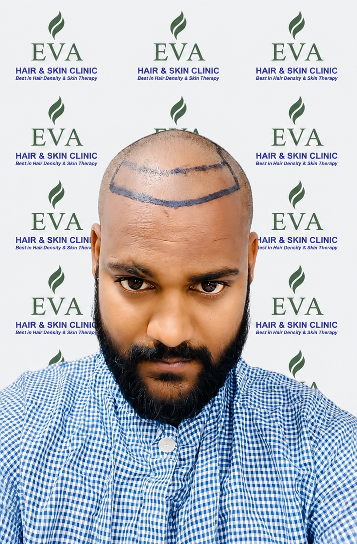 Before hair transplant result 3